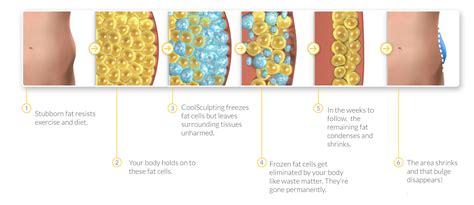 CoolSculpting Fat Freezing: How It Works, Side Effects, .